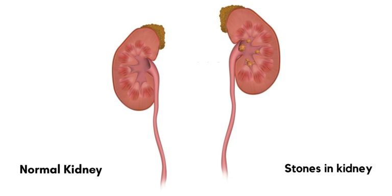 Are Kidney Stones Genetic What Causes Kidney Stones