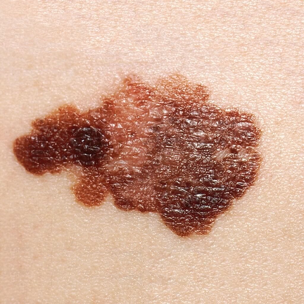 Melanoma Skin Cancer May Be Lethal If Not Detected In Time
