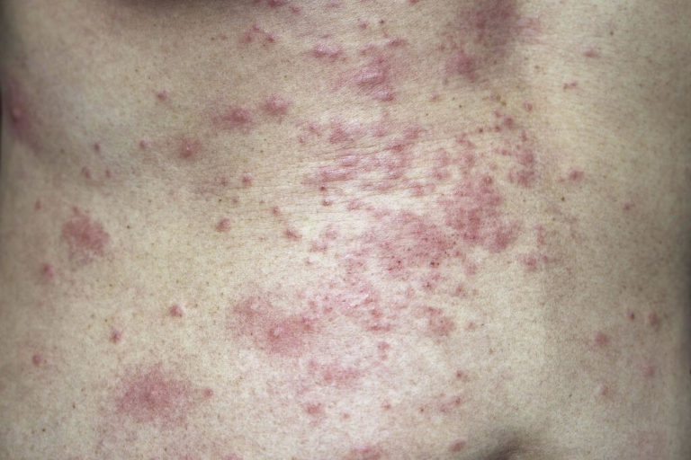 Pediatric Psoriasis And Skin Infections