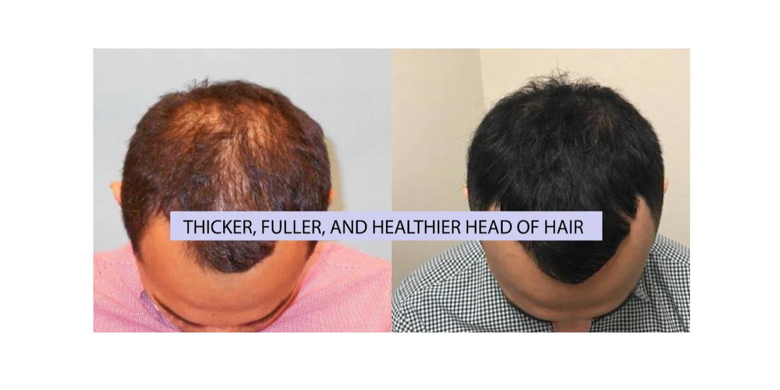 Hair loss supplement Results 