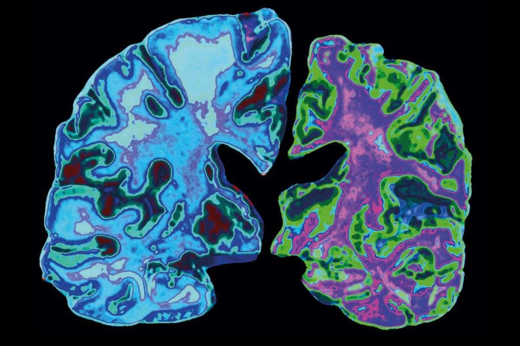 Testing For Inflammatory Proteins Can Help Diagnose The Progression Of Alzheimer's Disease
