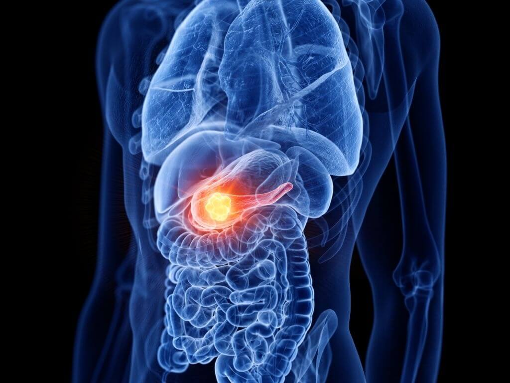 A-New-Technique-To-Treat-Pancreatic-Cancer-1