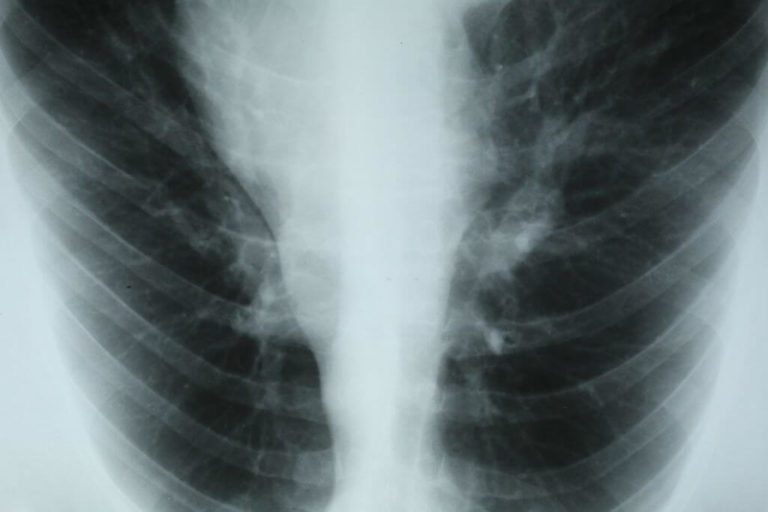 Access-To-Treatment-For-Pleural-Mesothelioma-Patients-Is-Limited-1