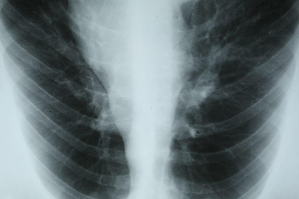 Access-To-Treatment-For-Pleural-Mesothelioma-Patients-Is-Limited-1