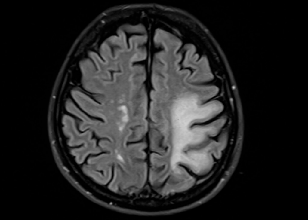 Los primeros signos de la enfermedad de Alzheimer en el tronco encefálico