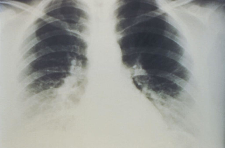 Lung-Function-Differences-Might-Spot-Risk-Of-Sudden-Cardiac-Deaths-In-People-1-1