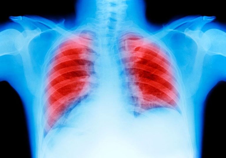 New-Research-Sheds-Light-On-Never-Smoker-Lung-Cancer-1