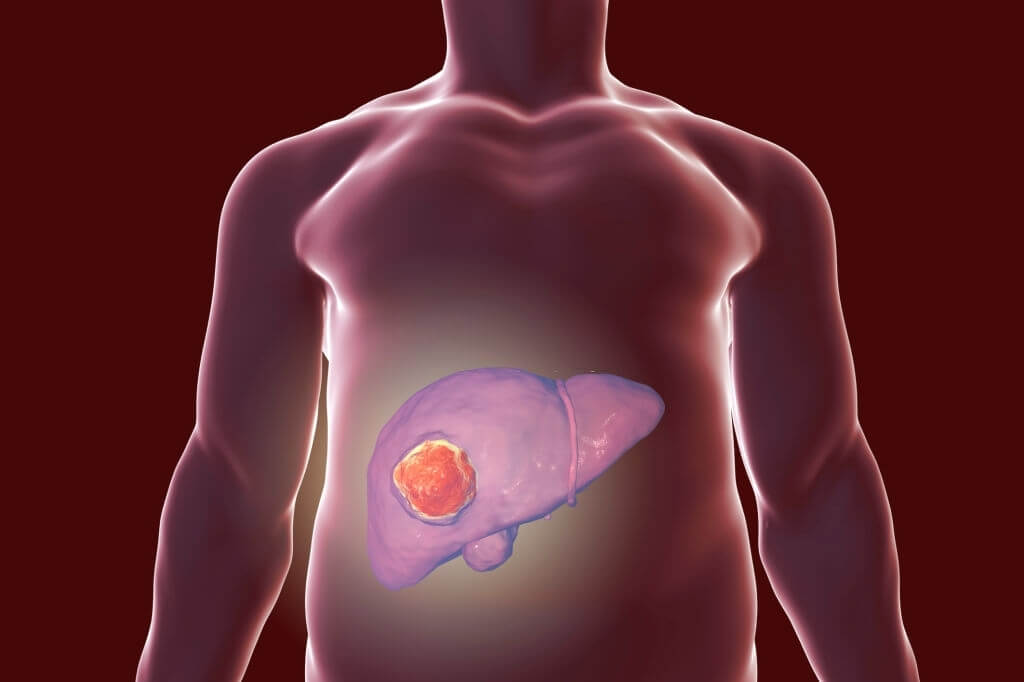 Rural-Liver-Cancer-Rates-Are-Growing-1