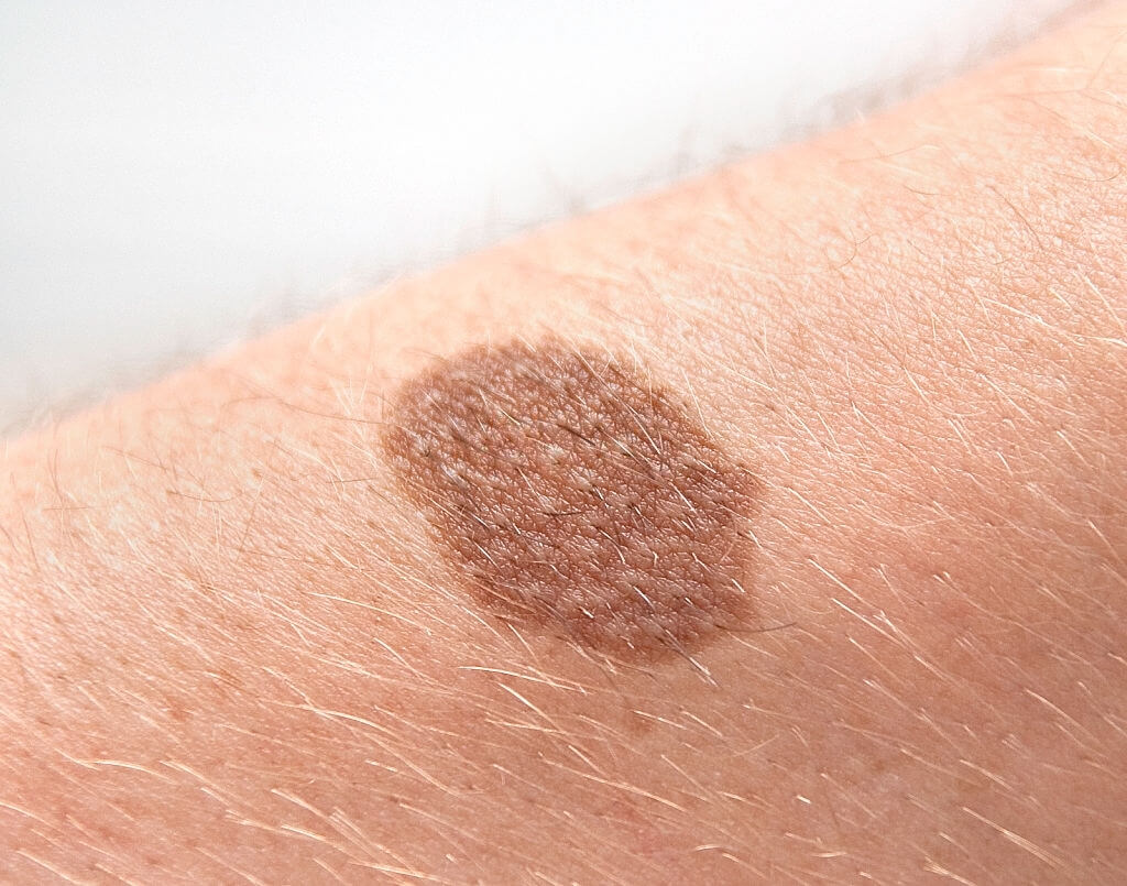 A-New-Technique-For-Boosting-The-Immune-System-To-Fight-Melanoma-1