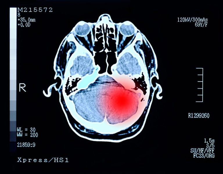 Migraine-Has-Been-Connected-To-Alzheimers-Disease-And-All-Cause-Dementia-1