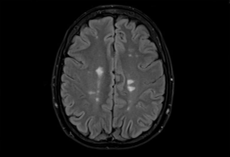 Multiple-System-Atrophy-Iron-Targeting-Brain-Therapy-1