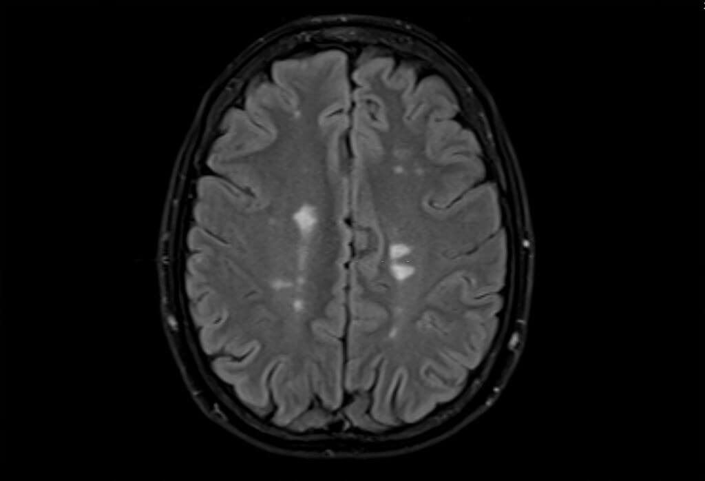 Multiple-System-Atrophy-Iron-Targeting-Brain-Therapy-1