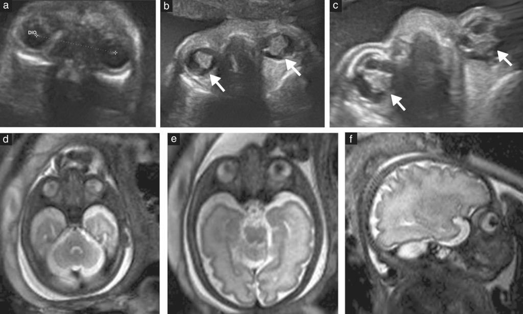 Protein Implicated In Uncommon Norrie Disease; Treatment Clues Found