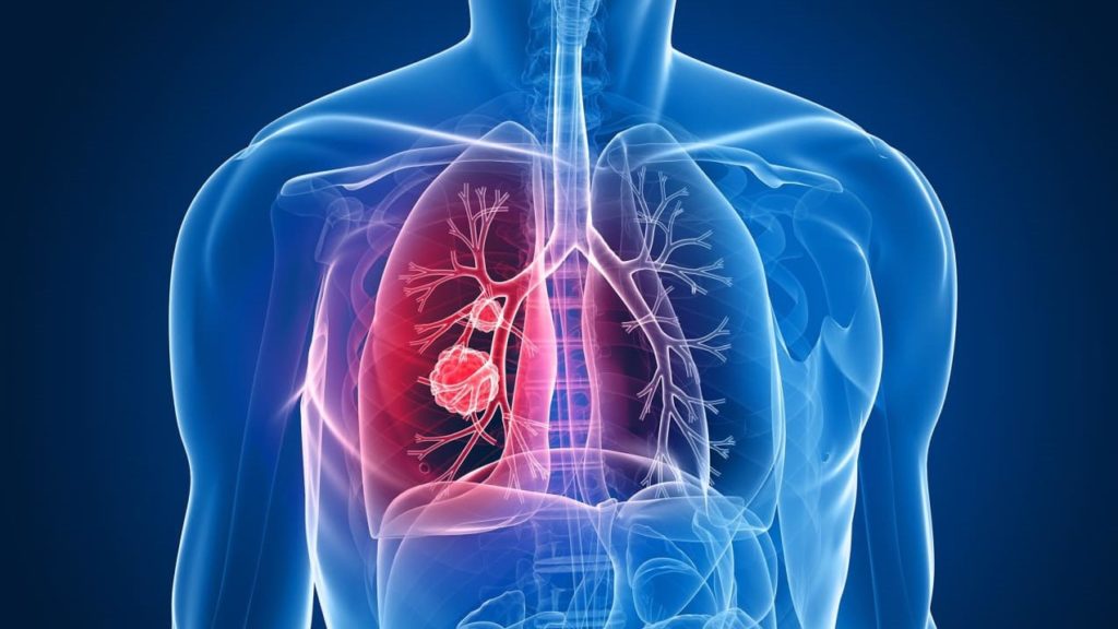 USPSTF Expands Lung Cancer Screening Eligibility In 2021