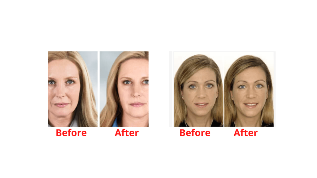 Collagen Select Results