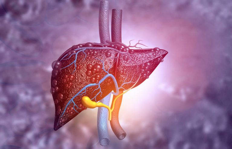 High-Serum-Iron-Levels-May-Increase-The-Risk-Of-Liver-Cancer-Among-NAFLD-Patients-1