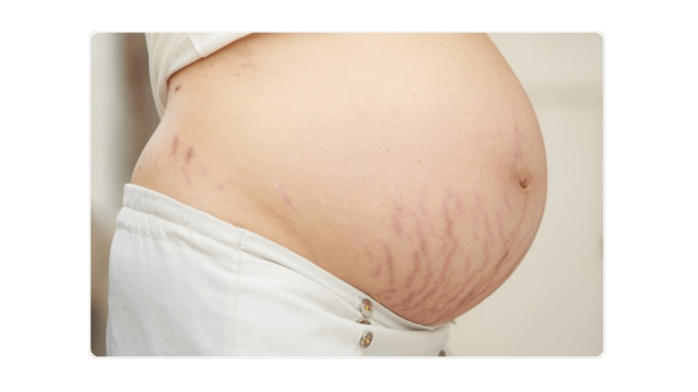 Pregnancy Stretch Marks Burden Women Emotionally And Physically