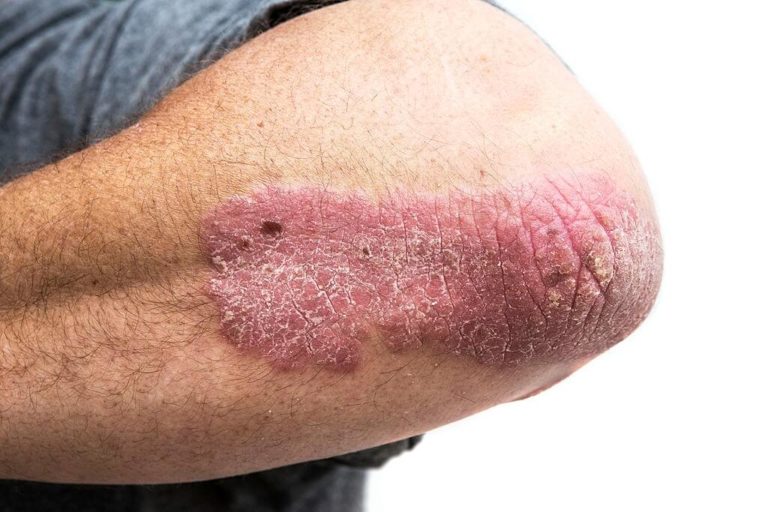 Trio Set Of Proteins Are Reason Psoriasis Disease