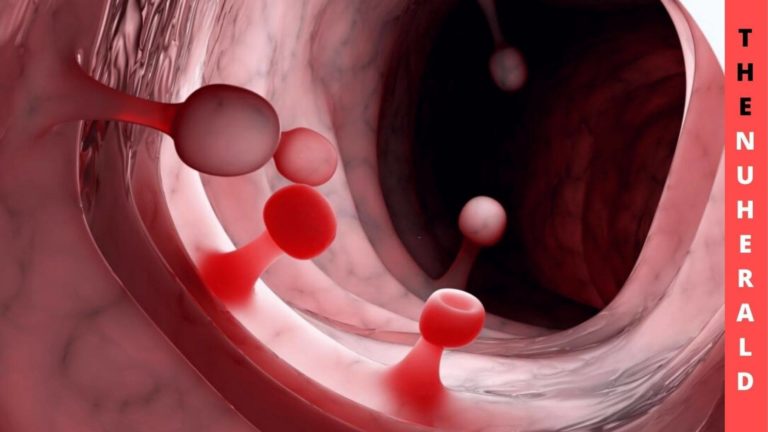 Screening Report Delays For Rural Women With Colorectal Cancer