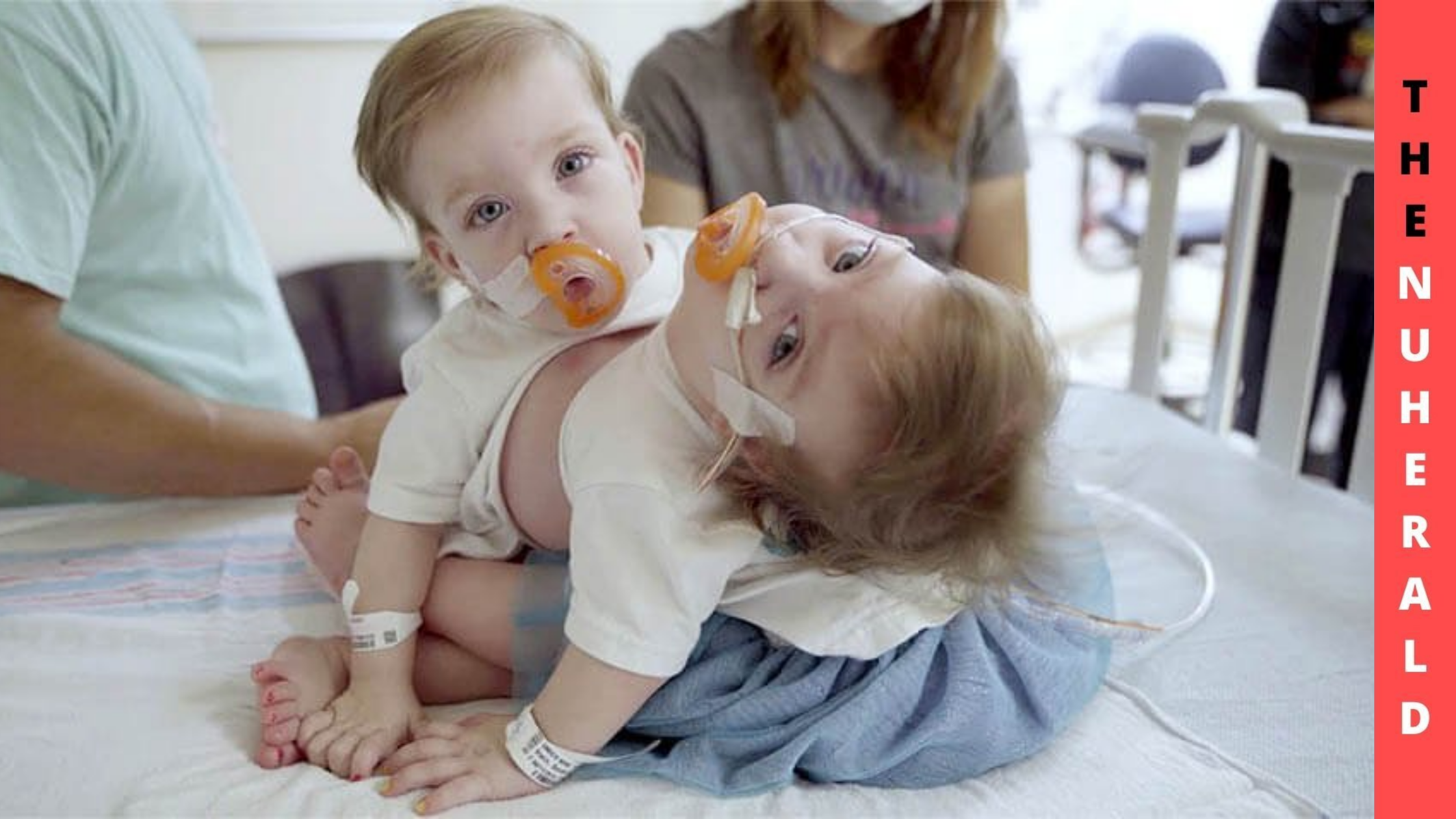 10 hour surgery to separate conjoined twins