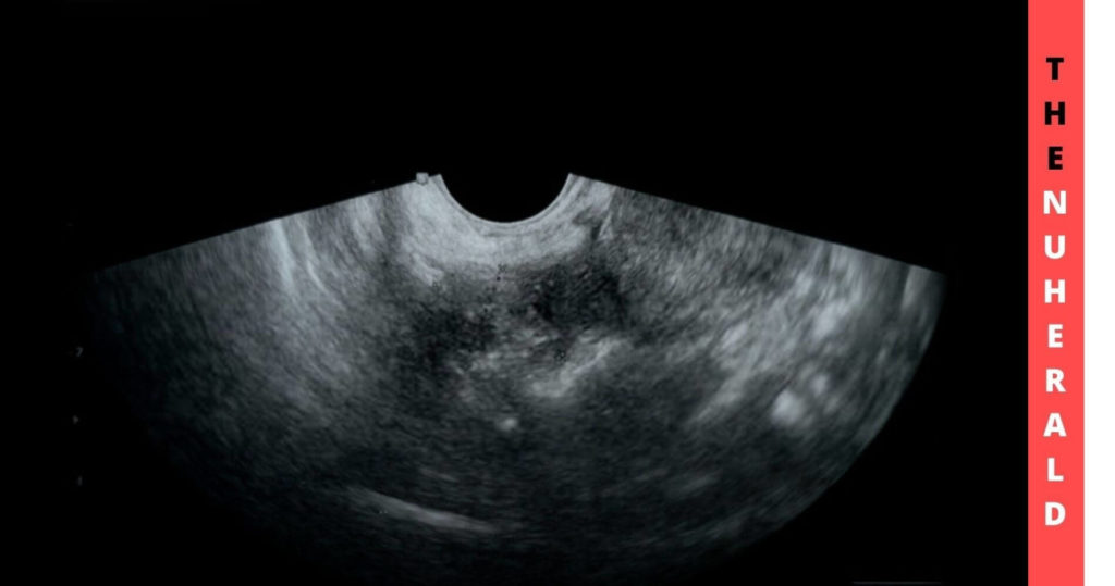Better Cancer Diagnosis With Improved Ultrasound Technology