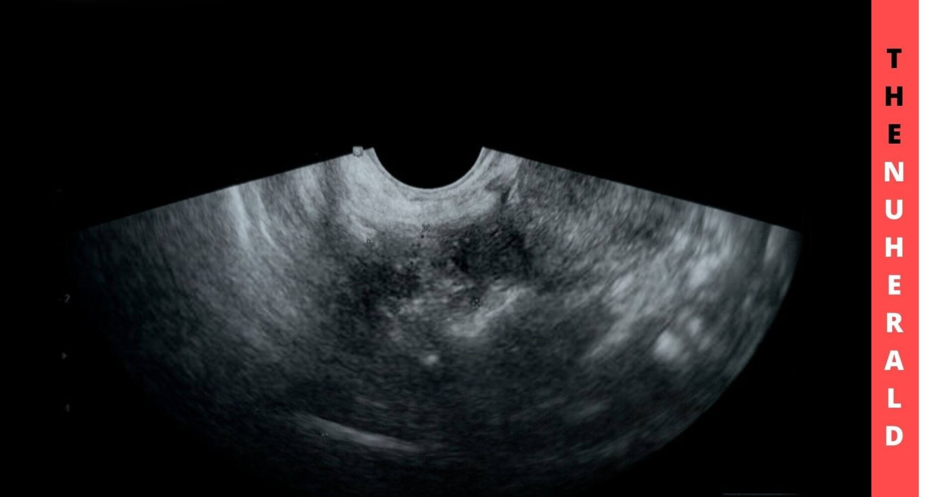 Better-Cancer-Diagnosis-With-Improved-Ultrasound-Technology