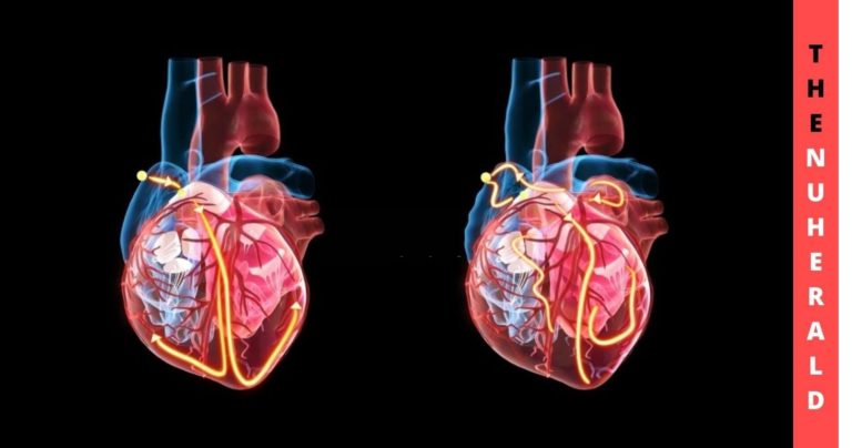 Atrial Shunt Device Not Suitable For All Heart Patients