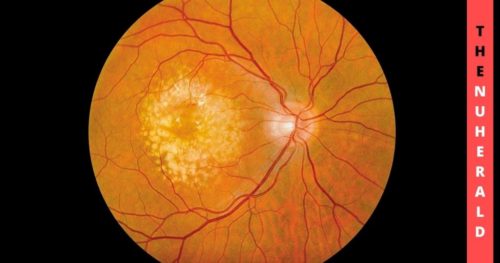 Destructive Outbreak Of Macular Degeneration And Its Signs 