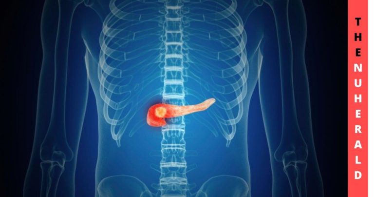 Researchers Discover Potential Cure For Pancreatic Cancer